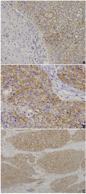CD147, MCT1 and MCT4 immunoexpressions in urothelial bladder carcinoma. Muscle-invasive tumours exhibiting cytoplasmic and membrane immunoexpression of CD147 (A, ×200 amplification), MCT1 (B, ×200 amplification) and MCT4 (C, ×100 amplification) in the malignant urothelium, with negative stromas (adapted from Afonso et al.71).