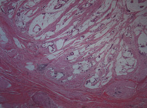 Infiltration of the bladder mucosa by mucinous adenocarcinoma. (Hematoxylin-eosin, 40×).