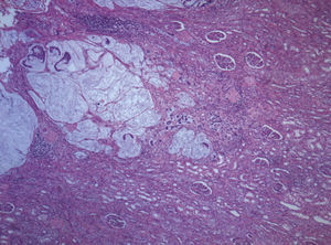 Infiltration of the renal parenchyma by mucinous adenocarcinoma. (Hematoxylin-eosin, 40×).