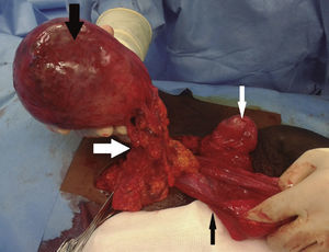 Appearance of the structures inside the right scrotum of the patient during the surgery; inside the right scrotum the patient had a healthy right testicle (thin white arrow) and spermatic cord together with an indirect inguinal hernia which sac (thin black arrow) was surrounding the big mass (thick black arrow); this mass was linked to the epiploon and splanchnic/mesenteric circulation (thick white arrow).