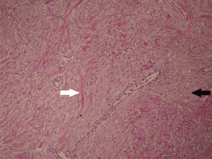 Photomicrograph of the tumor reveals a mesenchymal, spindled hypocellular proliferation in a stromal matrix, containing small to medium size blood vessels, composed by thick, eosinophilic collagen fibers (white arrow) with an admixture of more thin and light collagen fibers (black arrow) (hematoxylin-eosin, ×100).