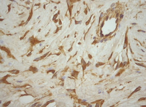 Immunohistochemical analysis showing that the neoplastic cells reacted positively with vimentin. (vimentin, ×40).