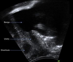 Imagem ecográfica em plano para‐sagital obtida com sonda transvaginal de divertículo da uretra feminino em relação com a parede uretral média posterior.