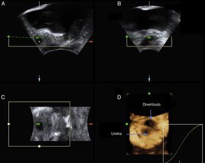 Imagens ecográficas obtidas com sonda transvaginal e reconstrução tridimensional de divertículo da uretra feminina.