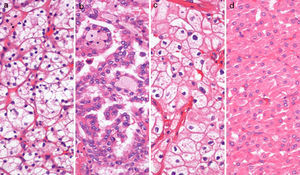 Renal cell tumors (RCTs) morphology: (a) clear cell renal cell carcinoma (ccRCC), (b) papillary renal cell carcinoma (pRCC), (c) chromophome renal cell carcinoma (chRCC) and (d) oncocytoma (hematoxylin and eosin staining 200×).