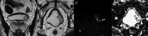 Exemplo de um tumor vesical localizado na parede lateral esquerda (*). A‐ T2 coronal B‐ T2 axial C‐ DWI (b1200) D‐ mapa ADC Nas sequências T2 observamos tumor vegetante, de sinal intermédio implantado na parede lateral esquerda da bexiga, que infiltra profundamente a parede vesical, condicionando descontinuidade focal da linha de hipossinal característica da muscularis própria, traduzindo tumor músculo‐invasivo. Estes achados são corroborados pelo estudo funcional de difusão, documentando‐se tumor com hipersinal em DWI e hipossinal no mapa ADC (setas).