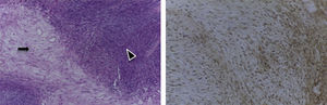 À esquerda tumor mostrando áreas celulares fusiformes‐padrão Antoni A (cabeça de seta) em coloração de H & E. À direita coloração imuno‐histoquímica com positividade difusa para a proteína S‐100.