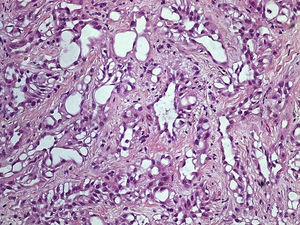 Tumor adenomatoide paratesticular – células epitelioides ou endotelioides dispostas em túbulos, cordões e pequenos ninhos, de núcleo regular com pequeno nucléolo e citoplasma eosinófilo ou vacuolizado, conferindo por vezes uma morfologia tipo anel de sinete (HE 200x).