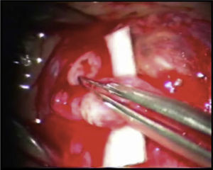 Dilatação inicial do topo abdominal (distal) do canal deferente com pinça (imagem gravada a partir do leitor de vídeo do microscópio).