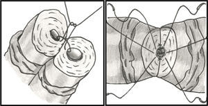 Técnica cirúrgica das 2 camadas: a sutura da mucosa é iniciada após a fixação do canal com 2‐3 pontos posteriores da camada externa. Os 7‐9 pontos circulares da mucosa são passados: muscularis‐mucosa‐mucosa‐muscularis, e atados sequencialmente no fim.