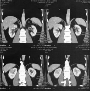 Resultados da tomografia axial computorizada abdominal com contraste (cortes longitudinais) – neoformação no polo renal superior direito.