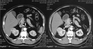 Resultados da tomografia axial computorizada abdominal com contraste (cortes transversais) – neoformação no polo renal superior direito.