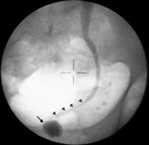 Pré‐operatório: bexiga de baixa capacidade (seta) e estenose do ureter terminal (setas pequenas) após injeção de contraste pelo cateter de nefrostomia.