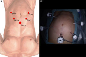 Observamos a posição das 5 portas de laparoscopia. Em A o esquema ilustrativo e em B uma fotografia real.