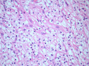 Histology of the resected renal cell carcinoma showing the characteristic findings of large clear cells. The cells are in a trabecular arrangement and feature clear cytoplasm and slight nuclear variability; H&E 400×.