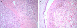 (a) Intrapancreatic metastasis from renal cell carcinoma; (b) Endoluminal growth in Wirsung duct. The lining epithelium of the Wirsung duct shows no cellular atypia; H&E 40×.