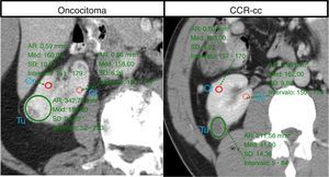 Determinação da atenuação de contraste em unidades de Hounsfield no tumor (Tu) e em 2 pontos diferentes medidos no córtex renal (cr).
