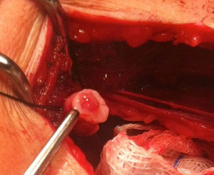 Imagem intraoperatória de pólipo do ureter proximal.