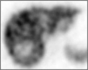 Cintigrafia hepatoesplénica com Tc99m – fígado com múltiplas áreas focais hipercaptantes, compatíveis com HNF. Área fria no segmento VI/VII.
