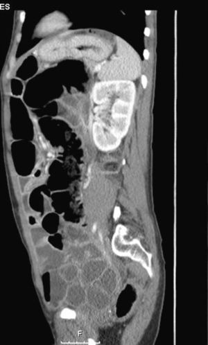 Abdominal CT during an episode of intestinal sub-occlusion.