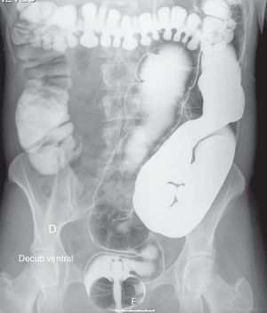 Double contrast opaque enema showing colonic distention without obstructive lesions or stenosis.