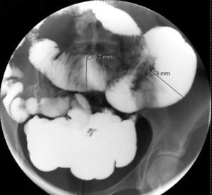 Small bowel transit showing marked distension of small bowel loops without obstructive lesions or stenosis.
