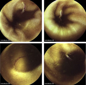Enteroscopia por videocápsula: múltiplos parasitas filiformes e esbranquiçados, alguns deles ancorados à mucosa e com conteúdo hemático no seu interior.