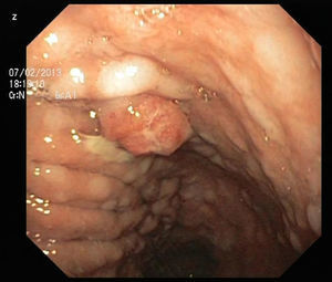 Upper gastrointestinal endoscopy showing a 15mm polypoid lesion with central ulceration in the anterior wall of gastric body and papulous gastropathy.