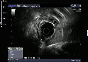 Endoscopic ultrasound showing a hypoechoic lesion of regular borders, with 14×7mm, in the mucosa of gastric body (uT1N0).