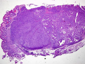 Histological examination (hematoxylin–eosin staining; magnification 20×) of the resected specimen showing a mixed carcinoma comprising a tubular well differentiated adenocarcinoma (on the right) and a neuroendocrine carcinoma (on the left), invading the submucosa and intercepted by the deep and lateral margins of resection.