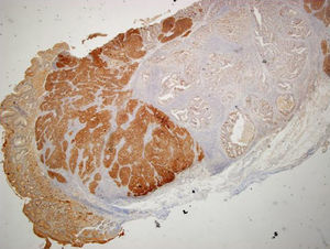 Immunohistochemical staining with synaptophysin (magnification 20×) showing diffuse positive staining by the neuroendocrine carcinoma component and negative staining by the adenocarcinoma component.