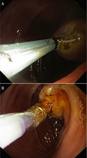 Endoscopic sphincterotomy (A) and endoscopic papillary balloon dilation (B), performed via a retrograde approach.
