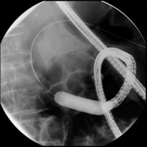 Fluoroscopic image of the fully expanded dilation balloon across the papilla, and visualization of the guidewire placed percutaneously.
