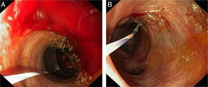 Direct cholangioscopy with the enteroscope showed a large bile duct stone (A), which was subsequently removed under direct visualization using a retrieval balloon (B).