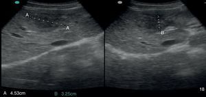Abdominal ultrasound: pseudonodular lesion, hypoechoic, heterogeneous and partially undefined in segment IV of the liver.