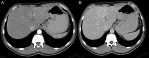 Contrast-enhanced computed tomography scan: low enhanced lesion in the arterial phase (A), with progressive enhanced in the late phase (B).