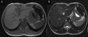 MRI: nodular lesion with lobulated and undefined limits, hypointense signal on T1 (A) and hyperintense signal on T2 (B).