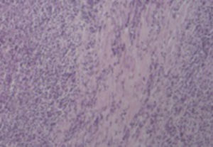 Histology of liver fragment: inflammatory pseudotumor (hematoxylin and eosin 100×).