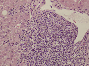Liver histology showed portal inflammatory infiltrate, predominantly mononucleate with lymphoid aggregates, mild piecemeal necrosis and moderate intra-lobular necro-inflammatory activity.