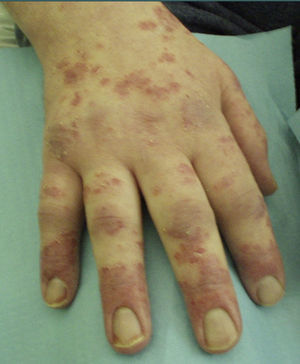 Hands of the patient with psoriatic-like eczema and arthritis.