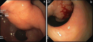 The initial diagnostic esophagogastroduodenoscopy revealed a smooth submucosal lesion in the distal gastric antrum (a), which appeared to prolapse through the pylorus into the duodenal bulb (b). Mucosal surface was erosioned and easy to bleed.