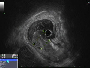 On EUS examination, a 50mm subepithelial tumor (SET) in the distal antrum was seen, with hypoechoic and heterogeneous echo pattern, located in the second and third sonographic layers of the gastric wall (deep mucosa and submucosa), with the intact fourth layer.