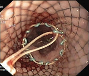 Endoscopic view of the collapsed distal flange of the stent.