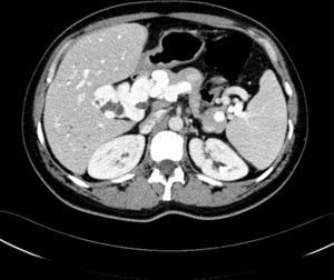 Axial image by contrast-enhanced CT of the abdomen showing the portal cavernoma encasing the common bile duct (CBD).