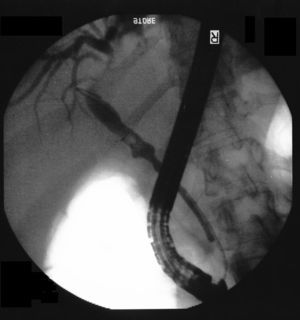 Cholangiogram during ERCP showing a saccular dilatation in the middle of the CBD with subtraction images compatible with calculi dilatation in its interior. The proximal portion of the CBD was also dilated while the diameter of the distal half remained normal.