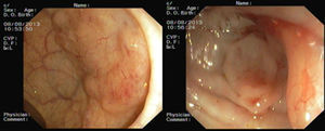 Subepithelial lesions at 10 and 18cm from the anal verge (left and right, respectively).