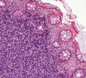 Lymphoid neoplasia, with “invasion” of the epithelium (Hematoxylin–Eosin, 100×).