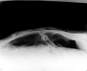 Abdominal plain radiography (supine position) demonstrated free air in the peritoneum and the internal bumper of the PEG tube in intraperitoneal location.