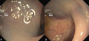Endoscopic images of the rectum revealing a large haematoma of the right wall (A), extending 10cm from the anal verge (B), with no signs of active bleeding.