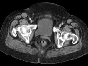 Computed tomography image showing perirectal air adjacent to the right rectal wall, suggesting perforation.